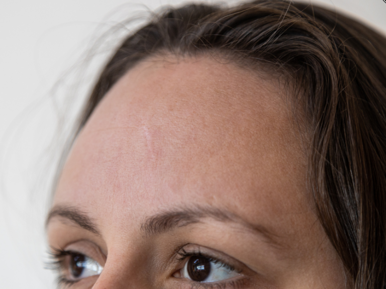 hairline definition (1)