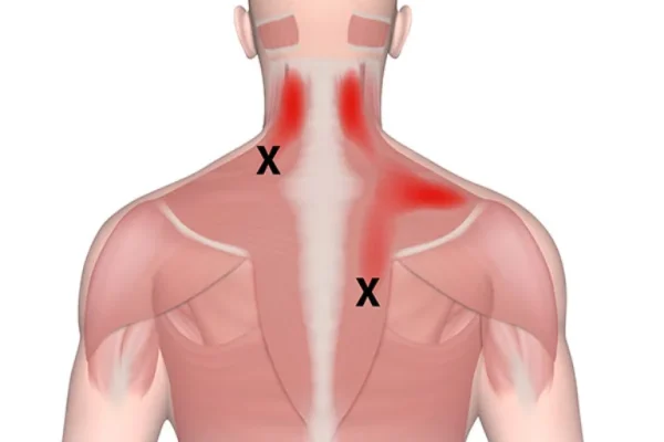 Anatomical diagram of the neck and upper back with red highlighted trigger points marked with X symbols.
